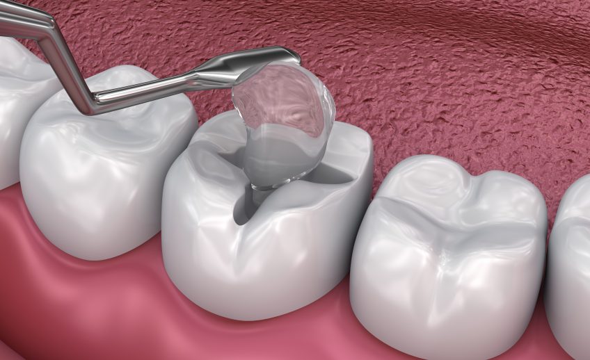 Kompositfüllung Zahnklinik ThermalDent Sárvár